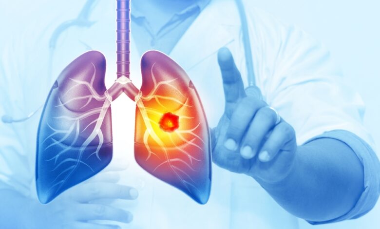 Her Yıl 25 Bin Akciğer Kanseri Vakası Önlenebilir Her Yıl 25 Bin Akciğer Kanseri Vakası Önlenebilir